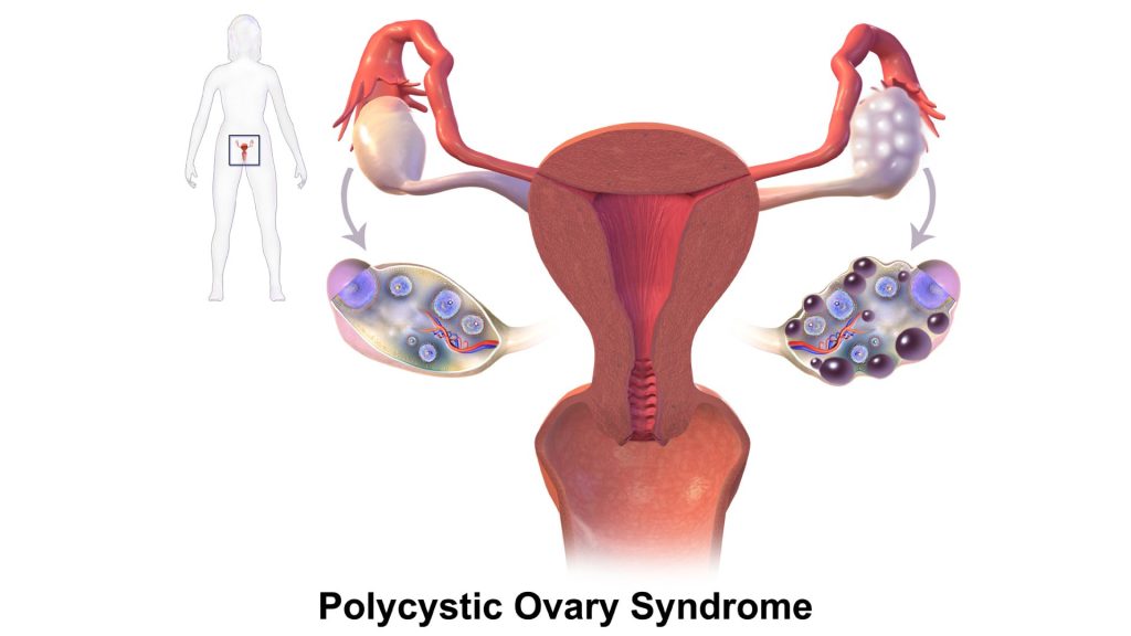 PCOS Treatment in Jaipur