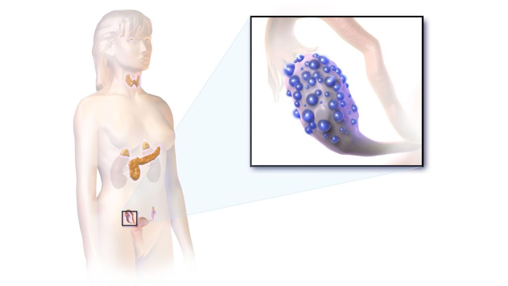 PCOS Treatment in Jaipur